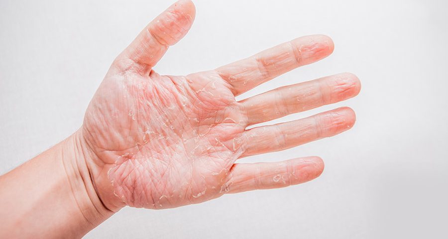 Qué es el eczema de manos? | Fundación Piel Sana