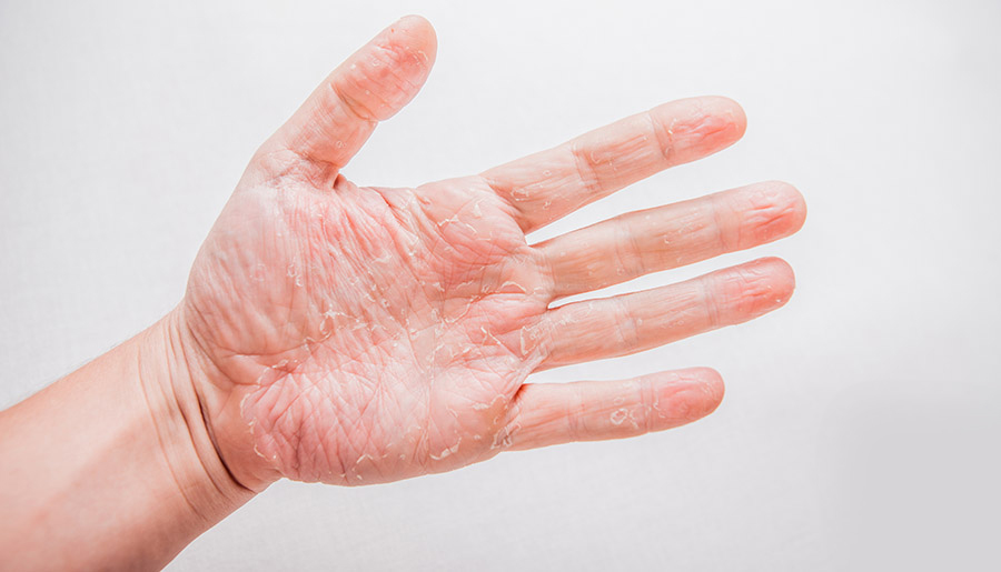 es el eczema de manos? | Fundación Piel Sana AEDV