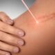laser-dermatologico