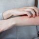 dermatitis-contacto